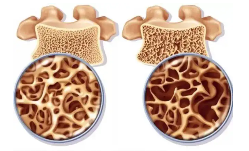 骨质疏松症